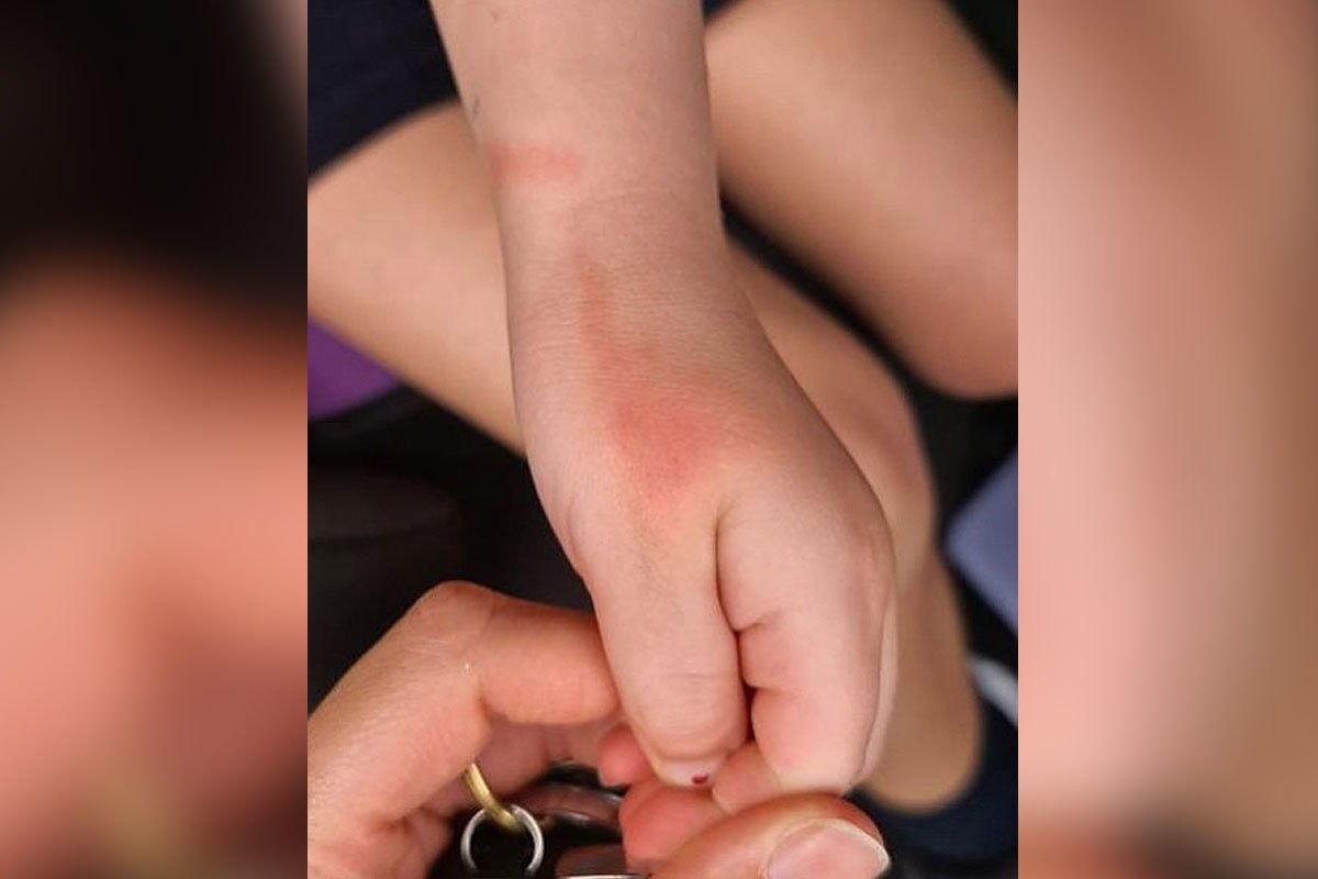 Мать заметила красные полосы на руке дочери и выяснила, что это симптом опасного заболевания - слайд 