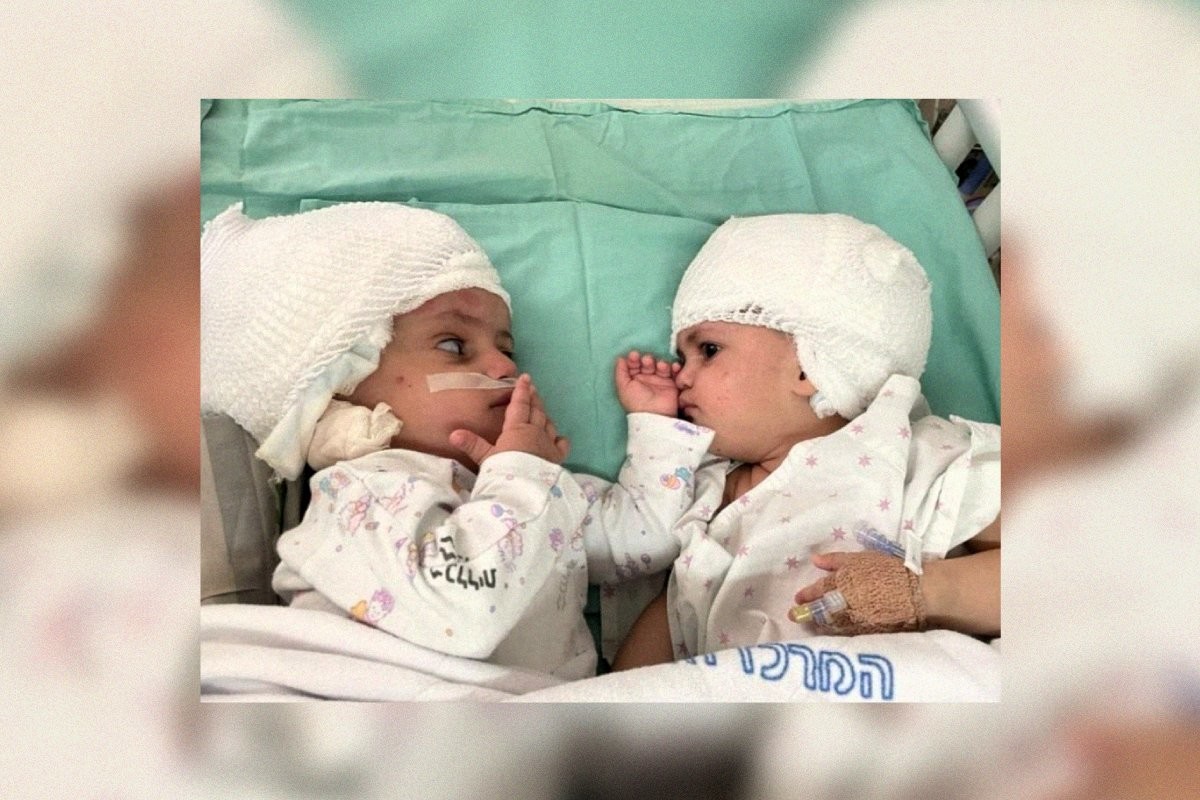 В Израиле разделенные сиамские близнецы впервые посмотрели друг на друга - слайд 