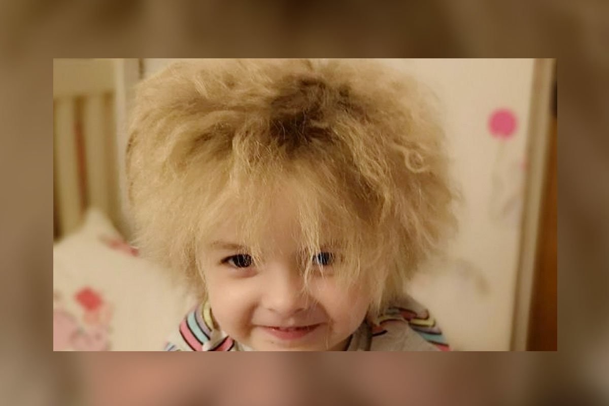 Прическа Эйнштейна: как живется девочке с синдромом нерасчесываемых волос - слайд 